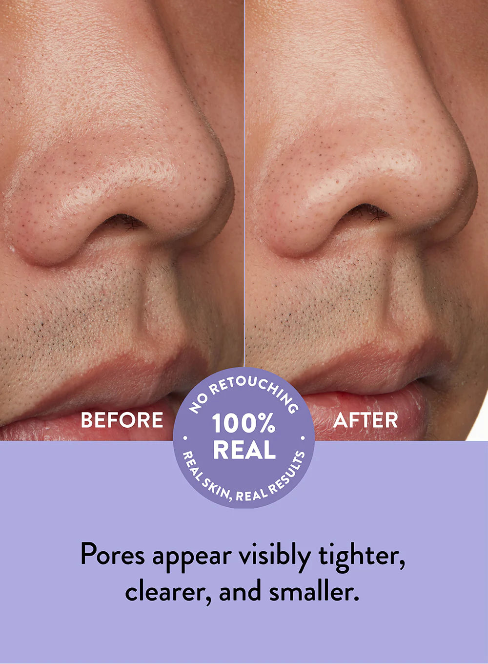 Acne System Nose pore patch